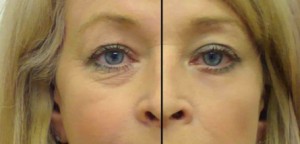 Eye secrets strips before and after